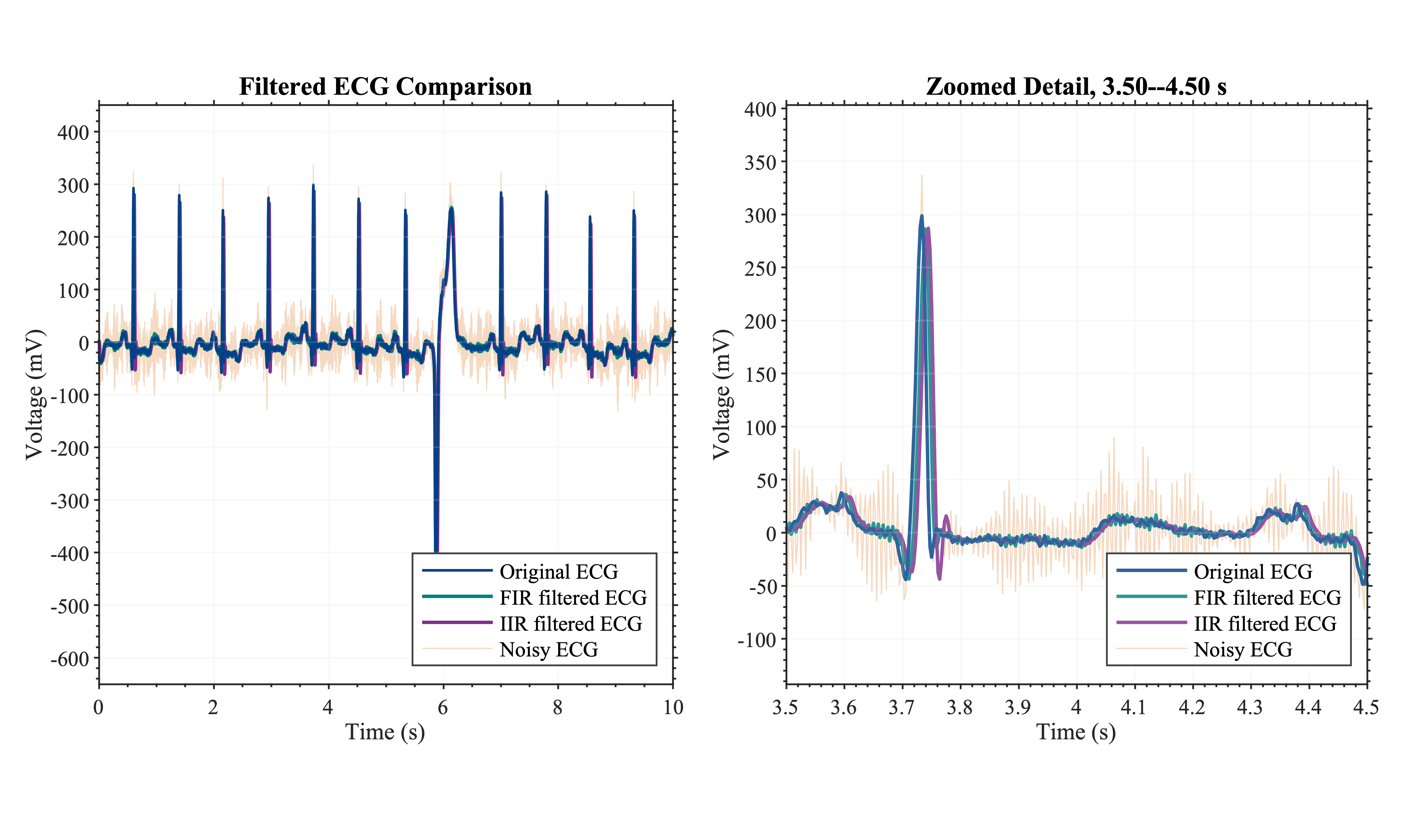 Full and zoomed ECG waveforms after causal FIR and IIR filtering