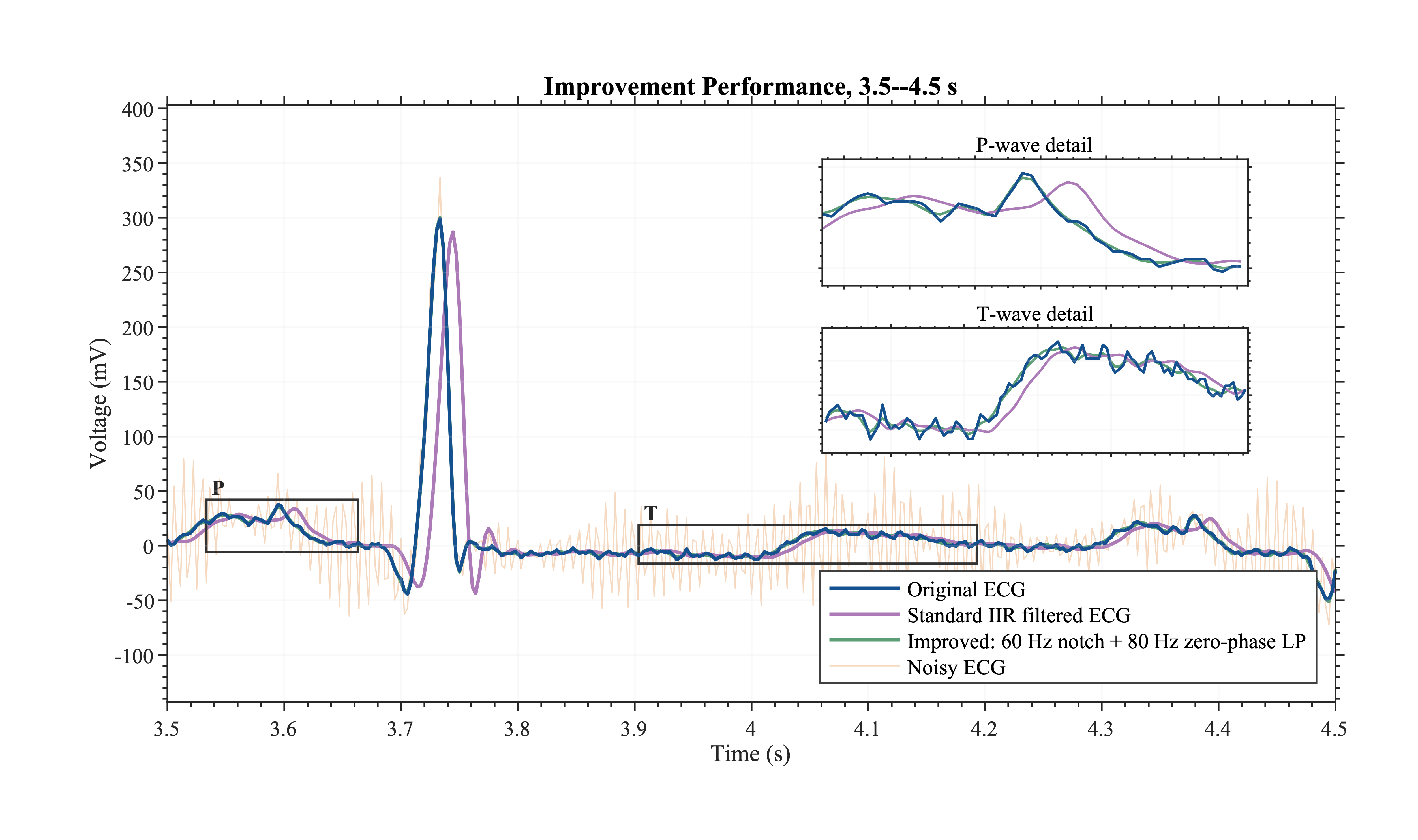 Improved ECG reconstruction with enlarged P-wave and T-wave regions